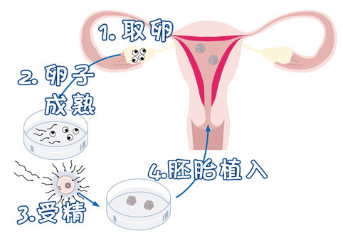 PGT三代试管